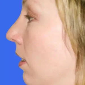 Rhinoplasty before and after photos