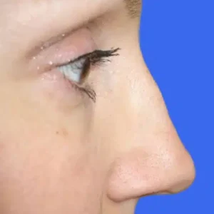 Rhinoplasty before and after photos