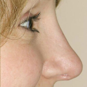 Rhinoplasty before and after photos