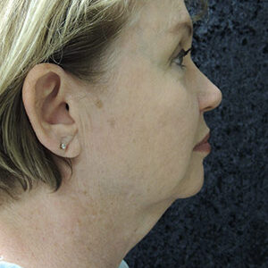 Laser Lift before and after photos