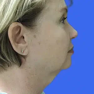 Laser Lift before and after photos