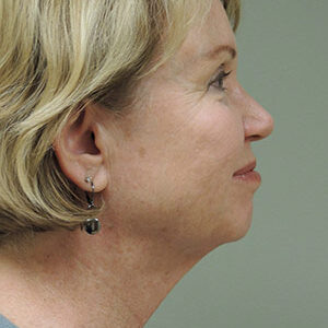 Laser Lift before and after photos