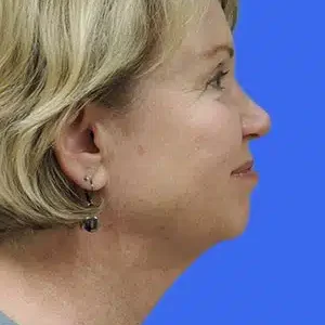 Laser Lift before and after photos