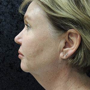 Laser Lift before and after photos