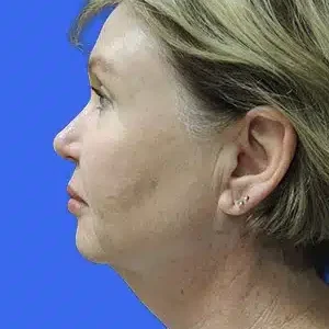 Laser Lift before and after photos