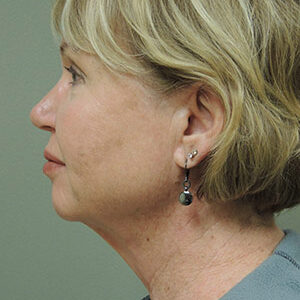 Laser Lift before and after photos