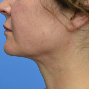 Laser Lift before and after photos