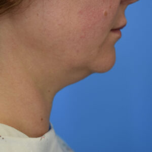 Laser Lift before and after photos