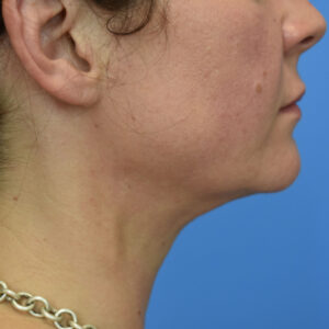 Laser Lift before and after photos