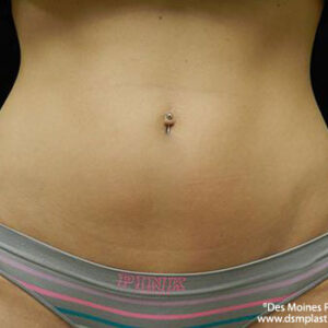 CoolSculpting before and after photos