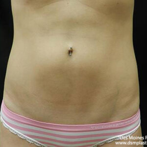 CoolSculpting before and after photos