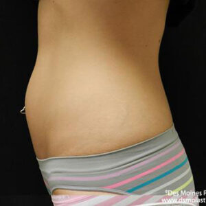 CoolSculpting before and after photos