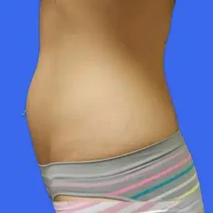 CoolSculpting before and after photos CoolSculpting before and after photos