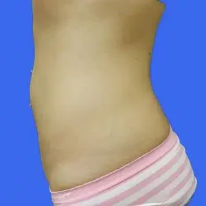 CoolSculpting before and after photos CoolSculpting before and after photos