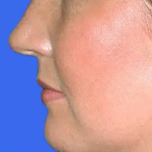 Neck Liposuction before and after photos