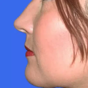 Neck Liposuction before and after photos