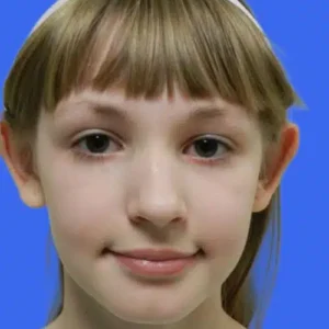 Ear Surgery before and after photos