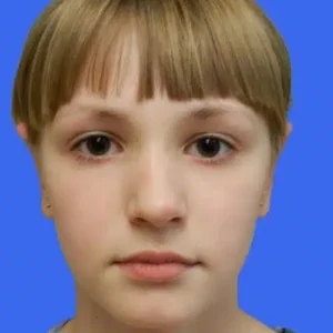 Ear Surgery before and after photos