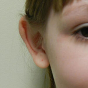 Ear Surgery before and after photos