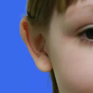 Ear Surgery before and after photos