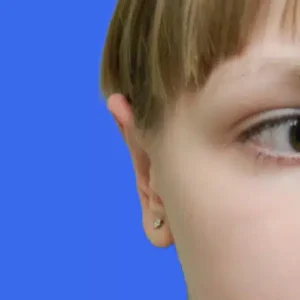 Ear Surgery before and after photos