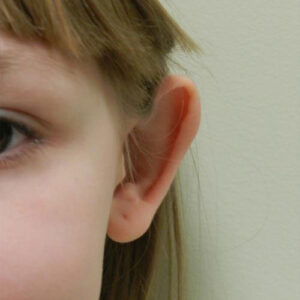 Ear Surgery before and after photos