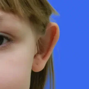 Ear Surgery before and after photos