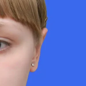 Ear Surgery before and after photos