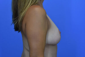 Breast Reduction before and after photos