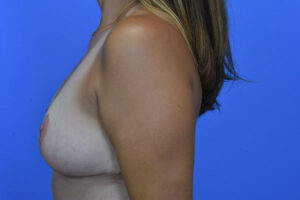 Breast Reduction before and after photos
