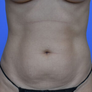 Liposuction before and after photos