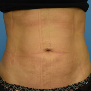 Liposuction before and after photos