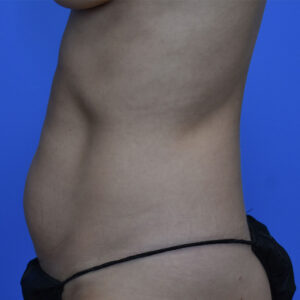 Liposuction before and after photos