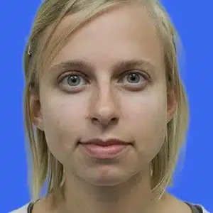 Chin Augmentation before and after photos