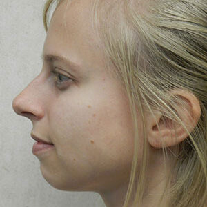 Chin Augmentation before and after photos