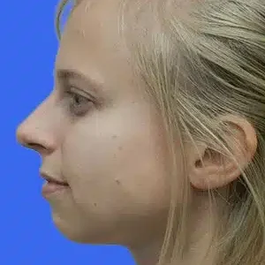 Chin Augmentation before and after photos