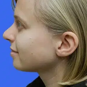 Chin Augmentation before and after photos