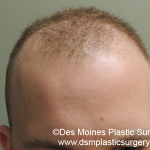 Neograft Hair Loss Replacement before and after photos