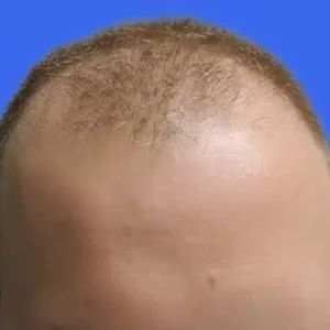 Neograft Hair Loss Replacement before and after photos