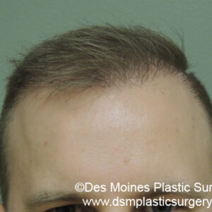 Neograft Hair Loss Replacement before and after photos