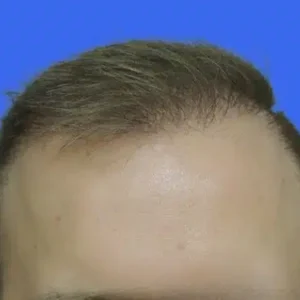 Neograft Hair Loss Replacement before and after photos