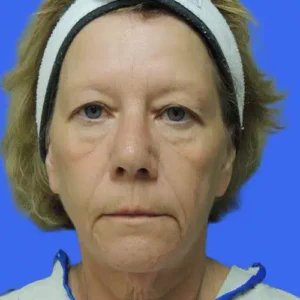 Face Lift before and after photos