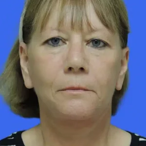 Face Lift before and after photos