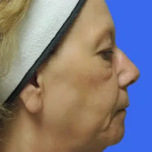 Face Lift before and after photos