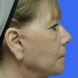 Face Lift before and after photos