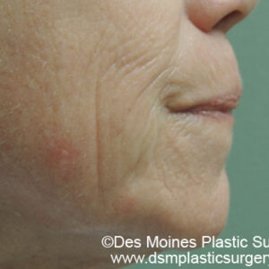 Laser Skin Resurfacing before and after photos