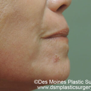 Laser Skin Resurfacing before and after photos