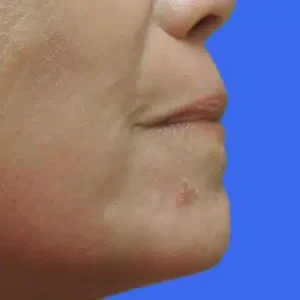 Laser Skin Resurfacing before and after photos