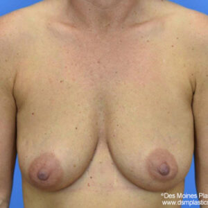 Breast Lift with Augmentation before and after photos