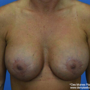 Breast Lift with Augmentation before and after photos